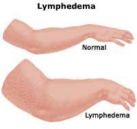 normal arm versus Lymphedema arm